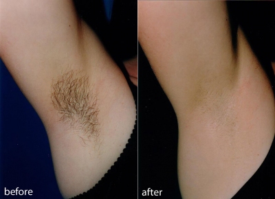 Blonde Hair Permanent Hair Removal For Blonde Hair